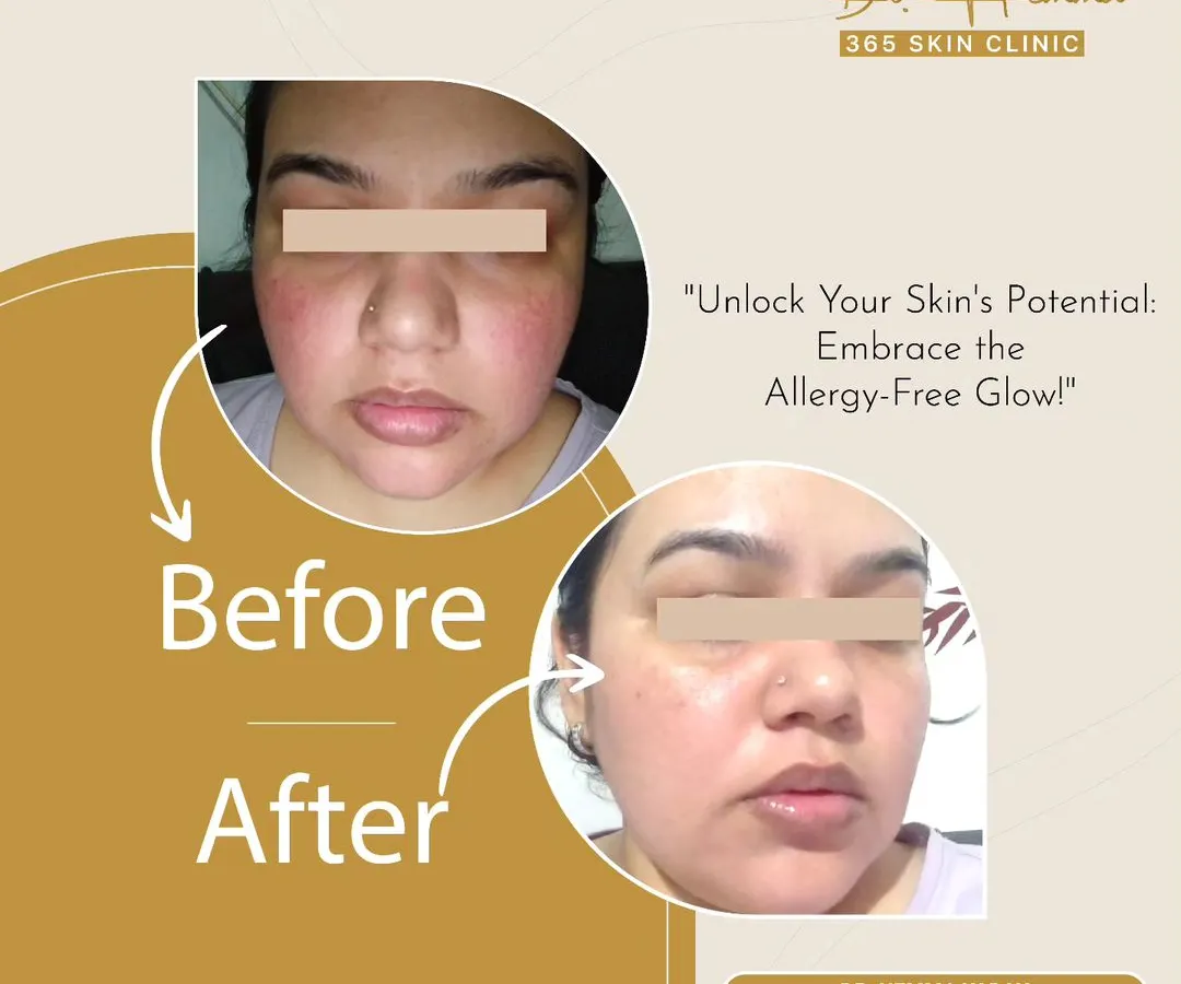 Skin allergies can be incredibly frustrating, causing redness, irritation, and discomfort. This client was struggling with persistent allergic reactions. Through a targeted treatment plan, we were able to calm the inflammation and restore her skin's natural barrier, revealing a clear and healthy complexion.