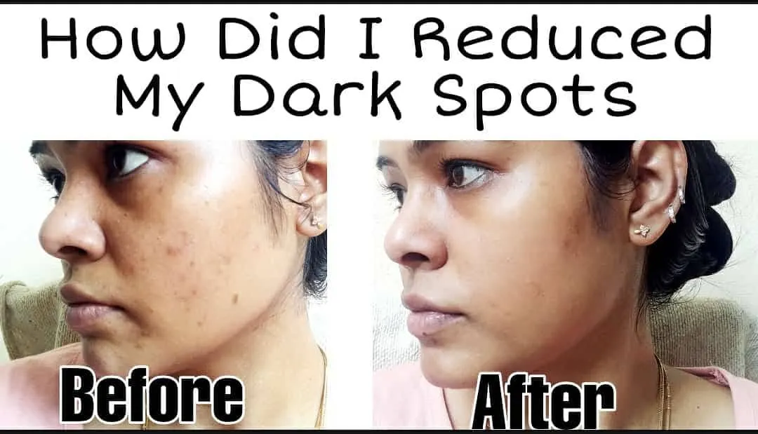 Many of you asked how I reduced my dark spots, so I wanted to share my journey. This image shows the difference after consistently using my DIY dark spot removal treatments. The spots have faded significantly, and my skin looks clearer and healthier.