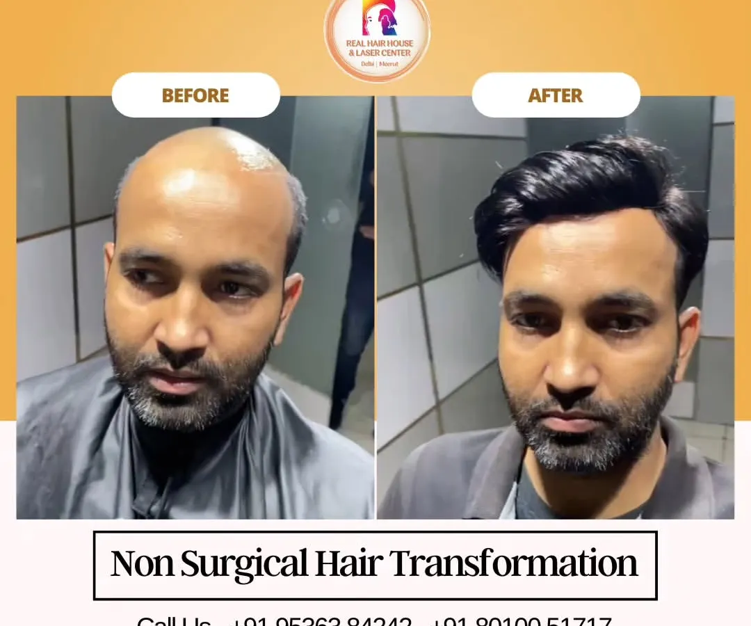 This before and after shows the power of non-surgical hair replacement. I addressed significant hair loss on the crown and hairline, resulting in a full, natural-looking head of hair.