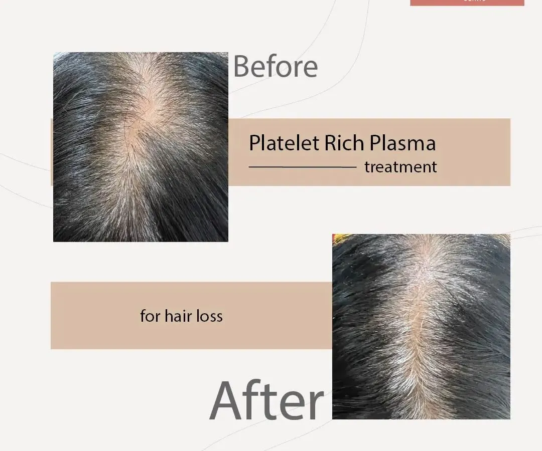 Here you can see the before and after results of a Platelet Rich Plasma (PRP) treatment. This non-surgical procedure is highly effective for tackling early-stage hair loss and thinning. Notice the significant improvement in hair density and scalp coverage, achieved by stimulating the hair follicles with the body's own healing properties.