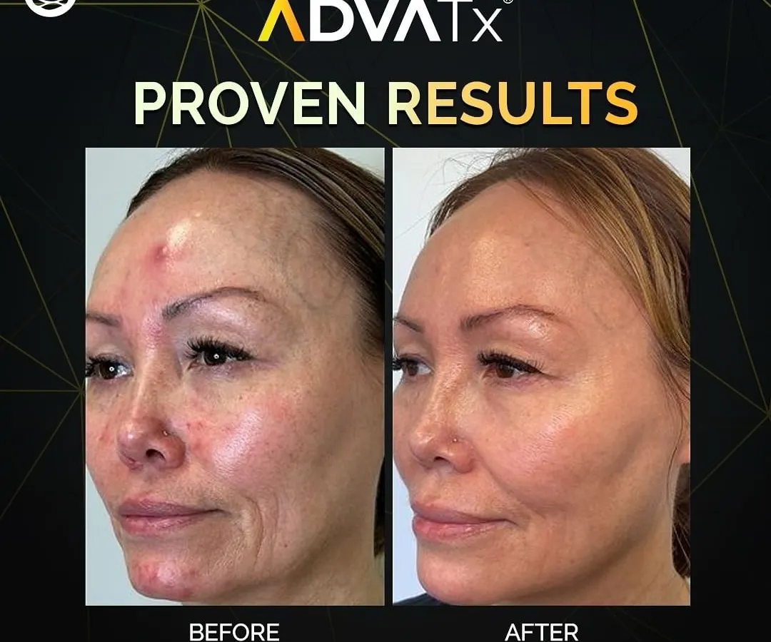 This before-and-after demonstrates the power of the AdvaTx laser. Notice the significant improvement in skin texture, reduction in redness, and overall rejuvenation after a tailored treatment course.
