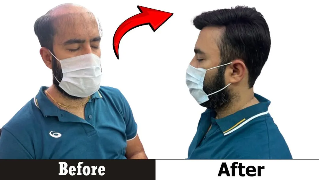 Look at the difference a quality hair patch makes. This client went from advanced baldness to a stylish, dense hairstyle that looks completely natural from the side profile.