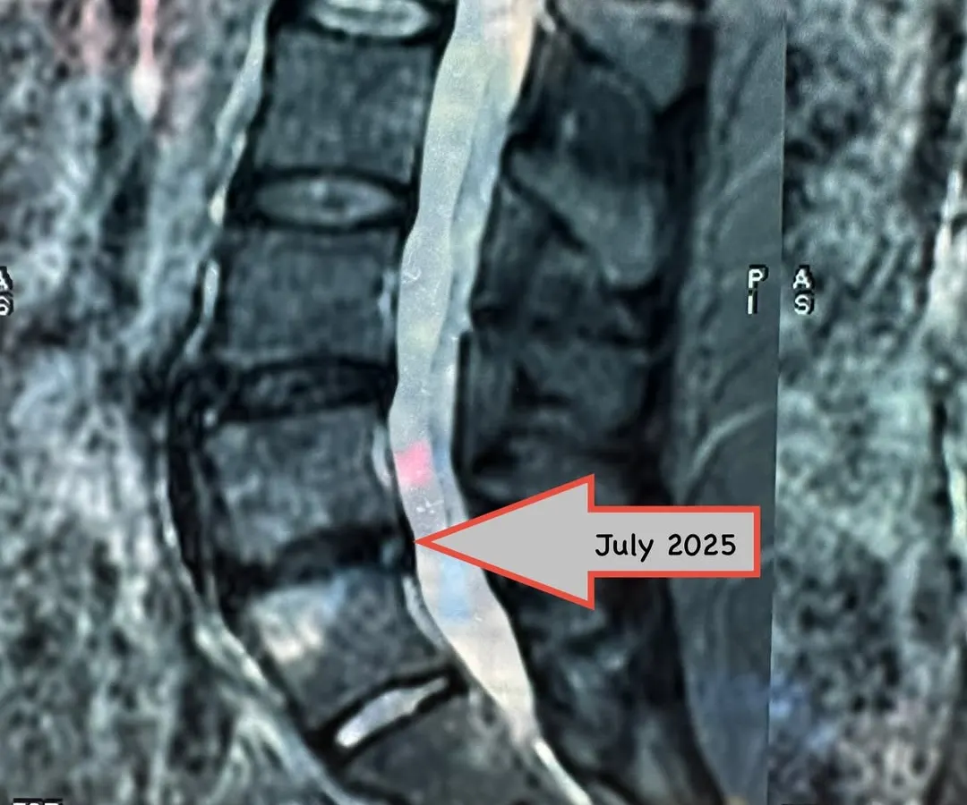 Here is the follow-up MRI after nine months of consistent, non-surgical physiotherapy. The disc has almost completely retracted, and the patient is now pain-free. This is the power of trusting the process.
