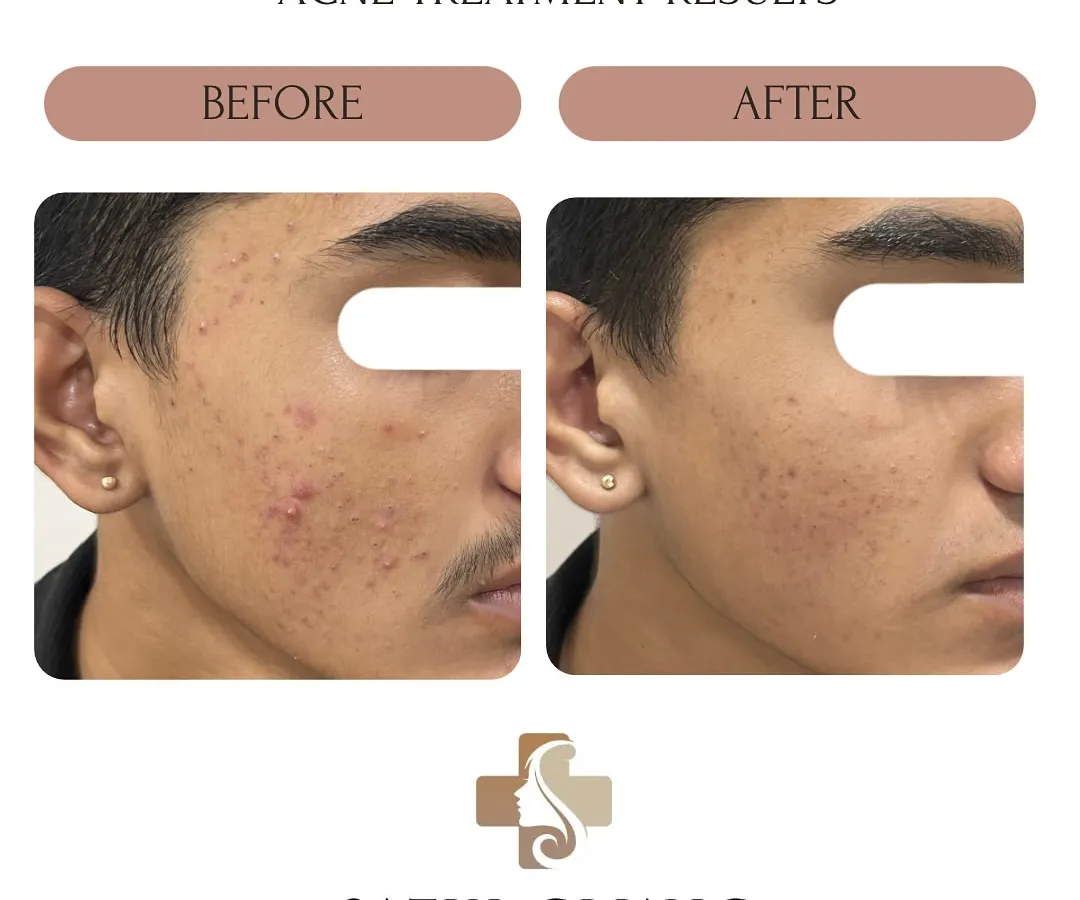 This is a clear example of how we can manage and control teenage acne. With a proper diagnosis and a consistent, simple routine, we were able to reduce active breakouts and inflammation, preventing future scarring.