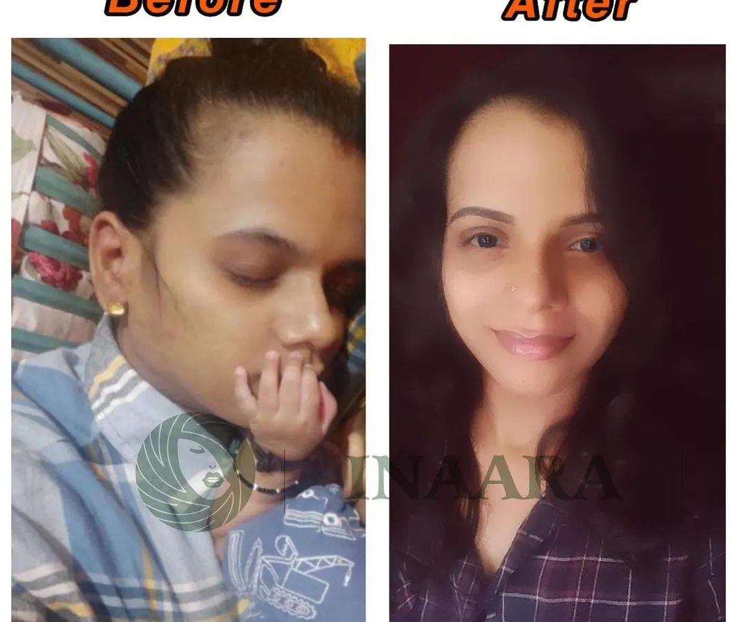 Postpartum hair fall can be distressing, but you don't have to go through it alone. This is a real before and after from one of my dear clients, showing how my products helped her regain hair density and confidence after childbirth.