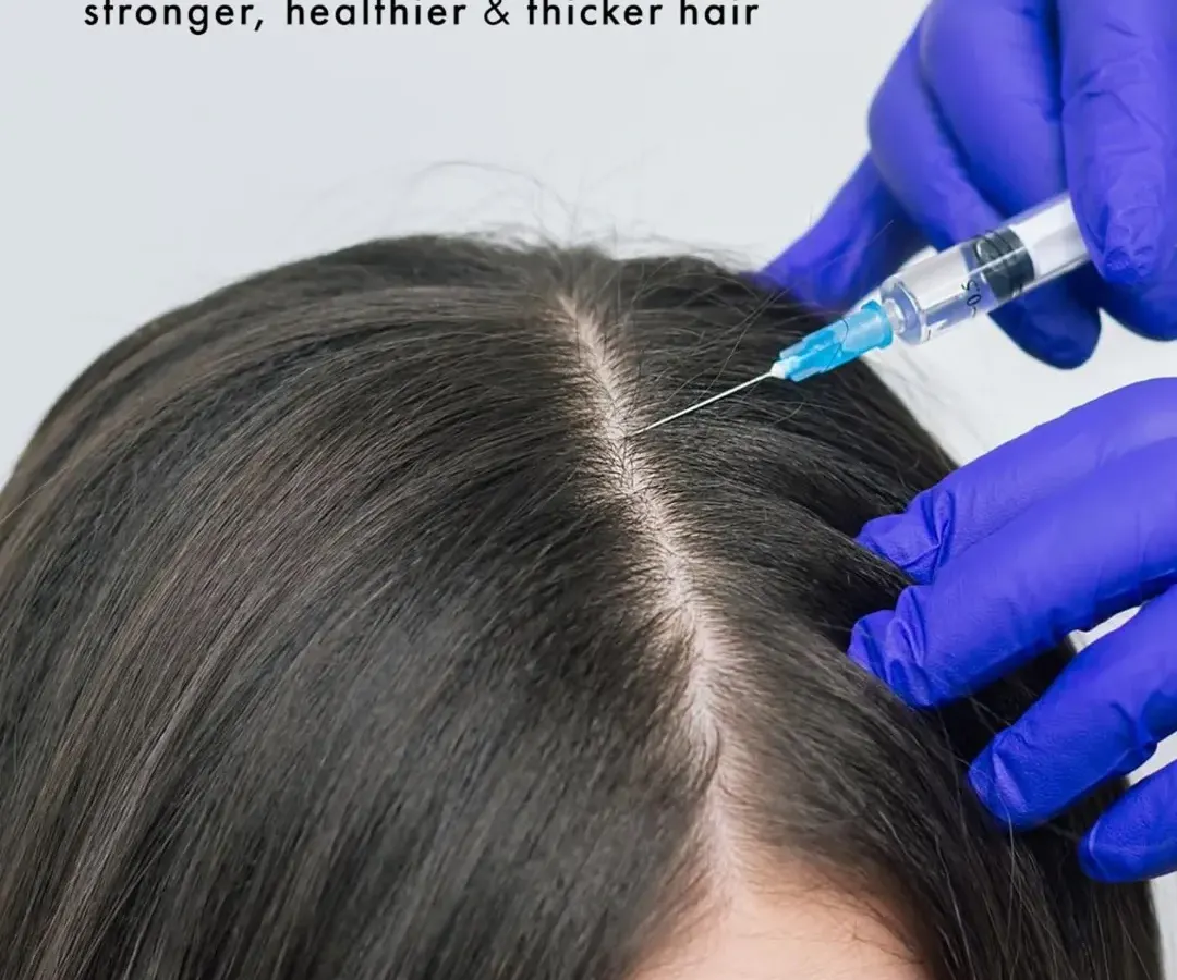 For women experiencing hair thinning or a widening parting, PRP treatment offers a targeted solution. I perform precise injections of platelet-rich plasma into the scalp to rejuvenate follicles, improve hair strength, and promote new, healthy growth.
