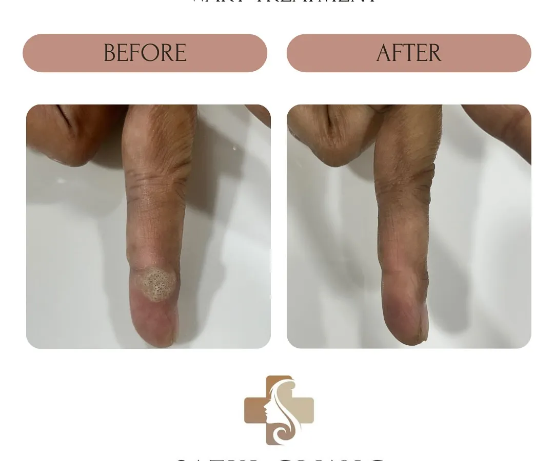 Here is a successful wart removal on a finger using intralesional immunotherapy. This non-surgical wart treatment works by activating the body's own immune system to fight the virus, avoiding cuts or burns and reducing the chance of scarring.