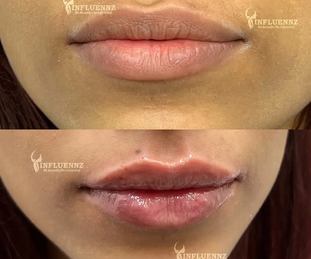 This is a great example of how lip fillers can enhance your natural beauty. We added subtle volume and definition to create a balanced, hydrated, and youthful pout. The goal is always to refine, not to change your look entirely.