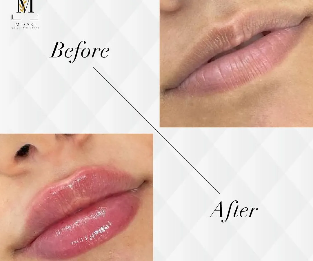 Here is a beautiful example of my lip filler work. I focus on enhancing the natural shape and restoring volume for a hydrated, balanced look, avoiding the overfilled or "duck" look.