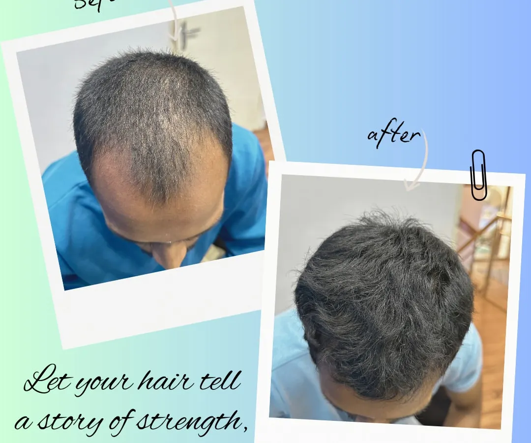 This before and after image shows the significant improvement in hair density following a course of Platelet-Rich Plasma (PRP) therapy. This non-surgical treatment uses the healing power of your own blood to reactivate dormant hair follicles, making it an effective solution for early-stage hair thinning and androgenetic alopecia.