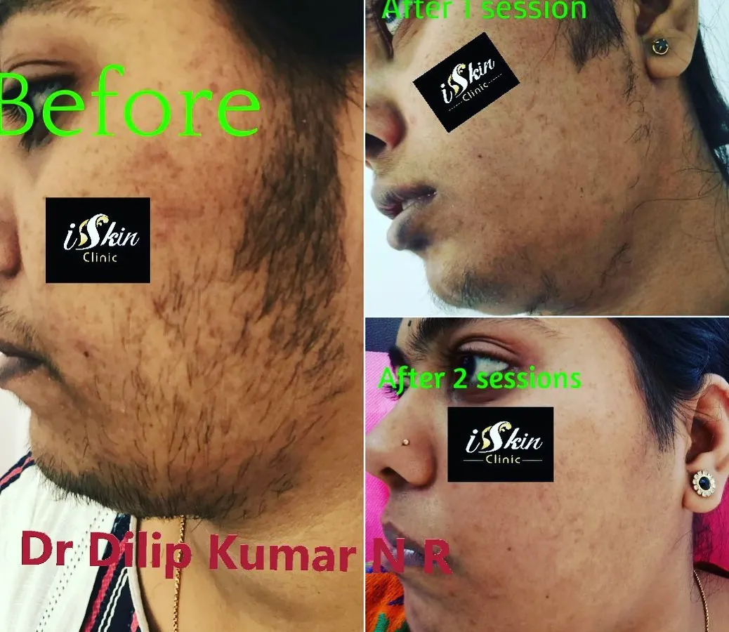 This series demonstrates the effectiveness of our laser hair reduction for the face. You can see the progressive results, from the initial state to significant hair removal after just one and then two sessions, leading to much smoother skin.