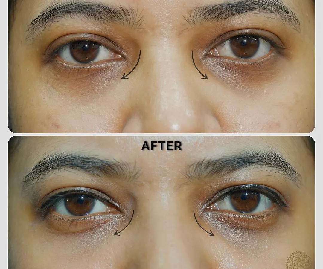 Tired-looking eyes are a common concern. Here, we used under-eye fillers to correct hollowness in the tear trough area, resulting in a smoother, brighter, and more rested appearance.