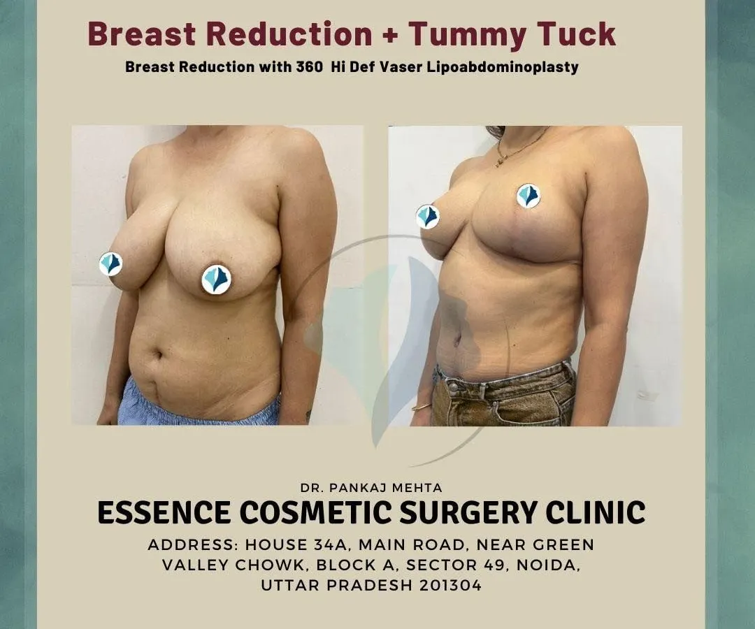This image shows the transformative result of a Mommy Makeover, combining a breast reduction with a 360 Hi-Def Vaser Lipoabdominoplasty. The 'after' photo displays lifted, more proportionate breasts and a significantly flatter, more toned abdomen.
