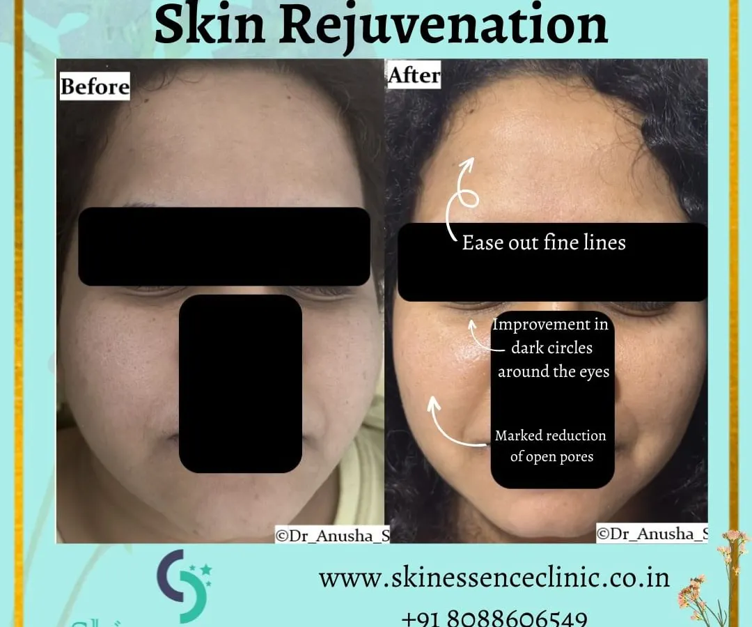 Here is a clear example of skin rejuvenation. Notice the visible reduction in open pores on the cheeks, the softening of fine lines, and the improvement in under-eye dark circles, leading to an overall smoother and refreshed appearance.