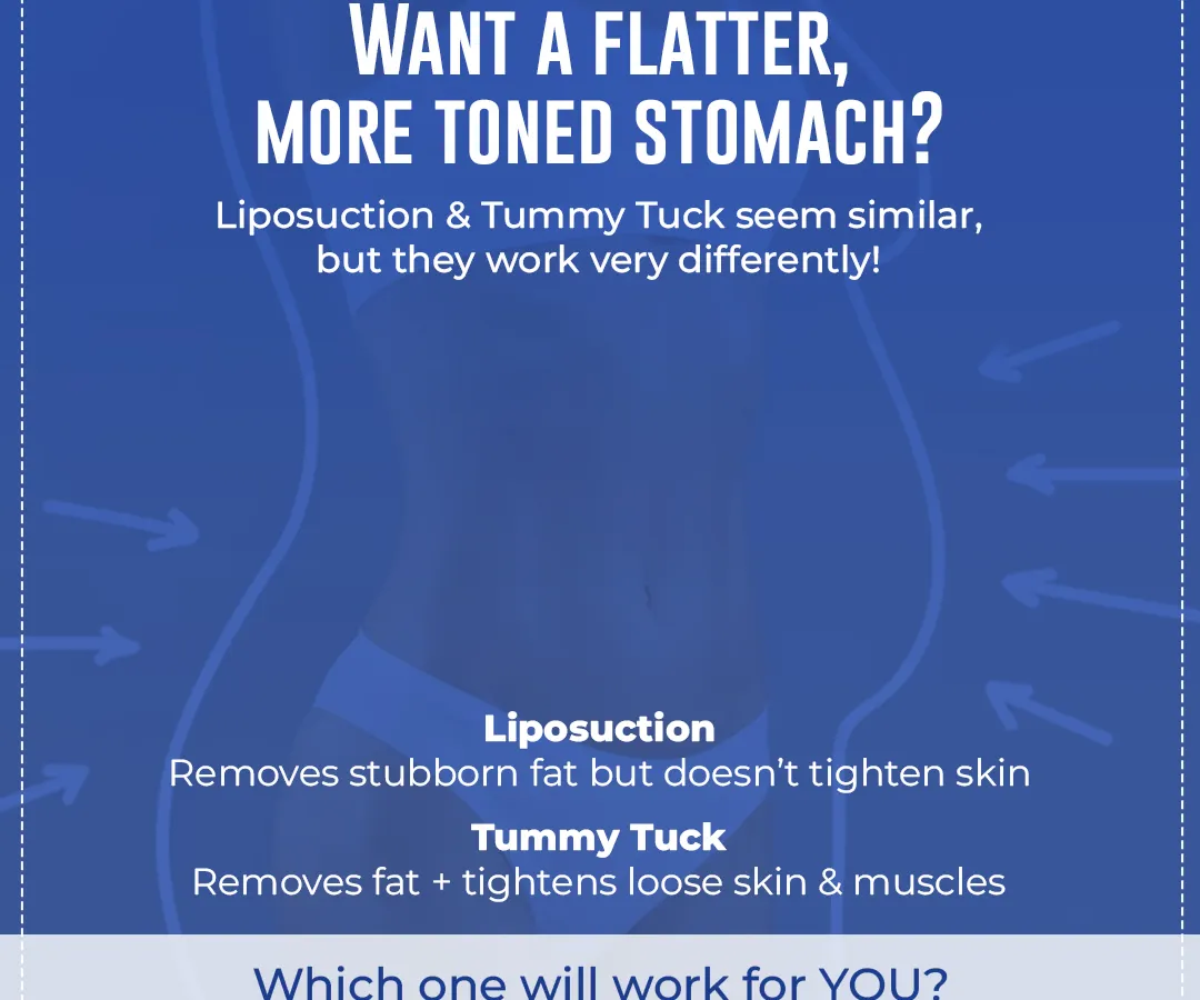 Many patients ask about the difference between a tummy tuck and liposuction. Liposuction is excellent for removing stubborn fat if your skin is firm, while a tummy tuck is designed to remove excess skin and tighten separated abdominal muscles, often after pregnancy or weight loss.