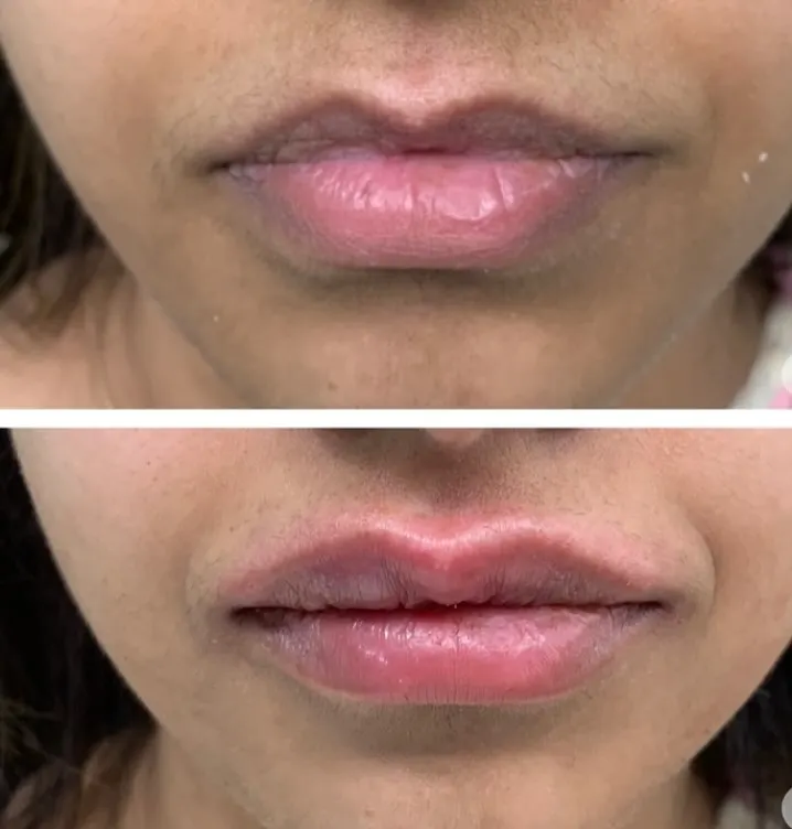 This before-and-after image shows the immediate, natural-looking result of a lip filler treatment. My approach focuses on restoring subtle volume and defining the lip shape to enhance your features, not alter them. The procedure is quick and provides a visible yet balanced enhancement.