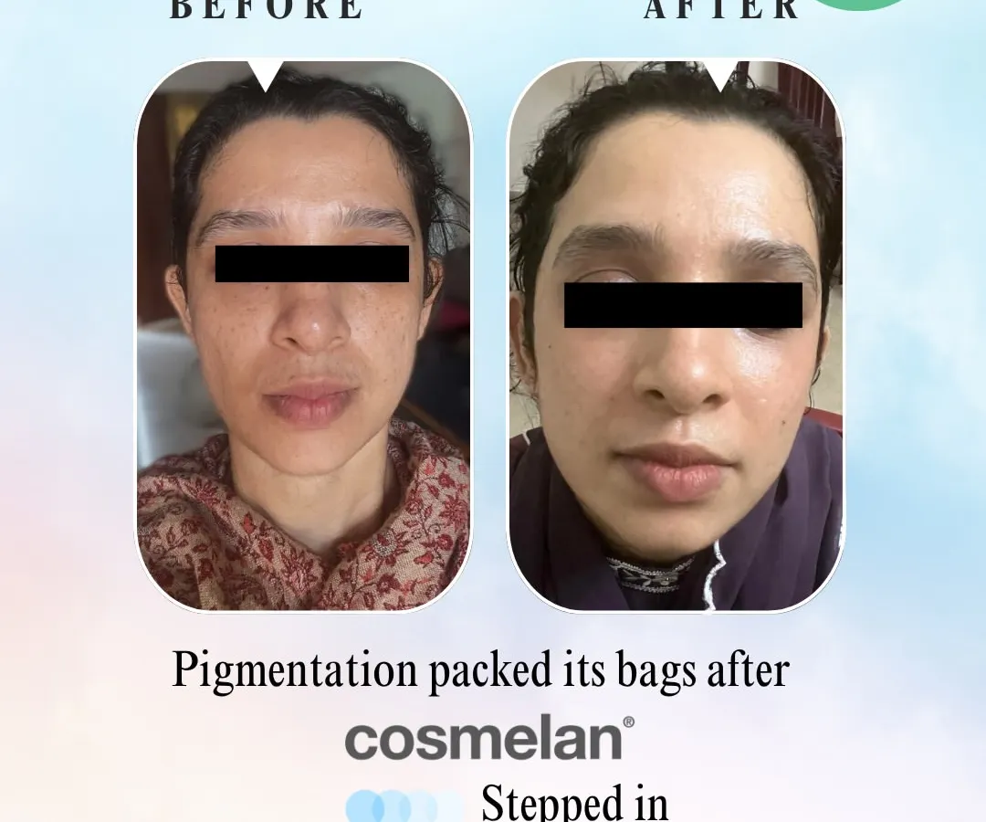 This is the power of a targeted, professional treatment plan. Our Cosmelan peel is a world-leading depigmentation method that effectively reduces stubborn melasma and hyperpigmentation, revealing a dramatically clearer and more even-toned complexion.