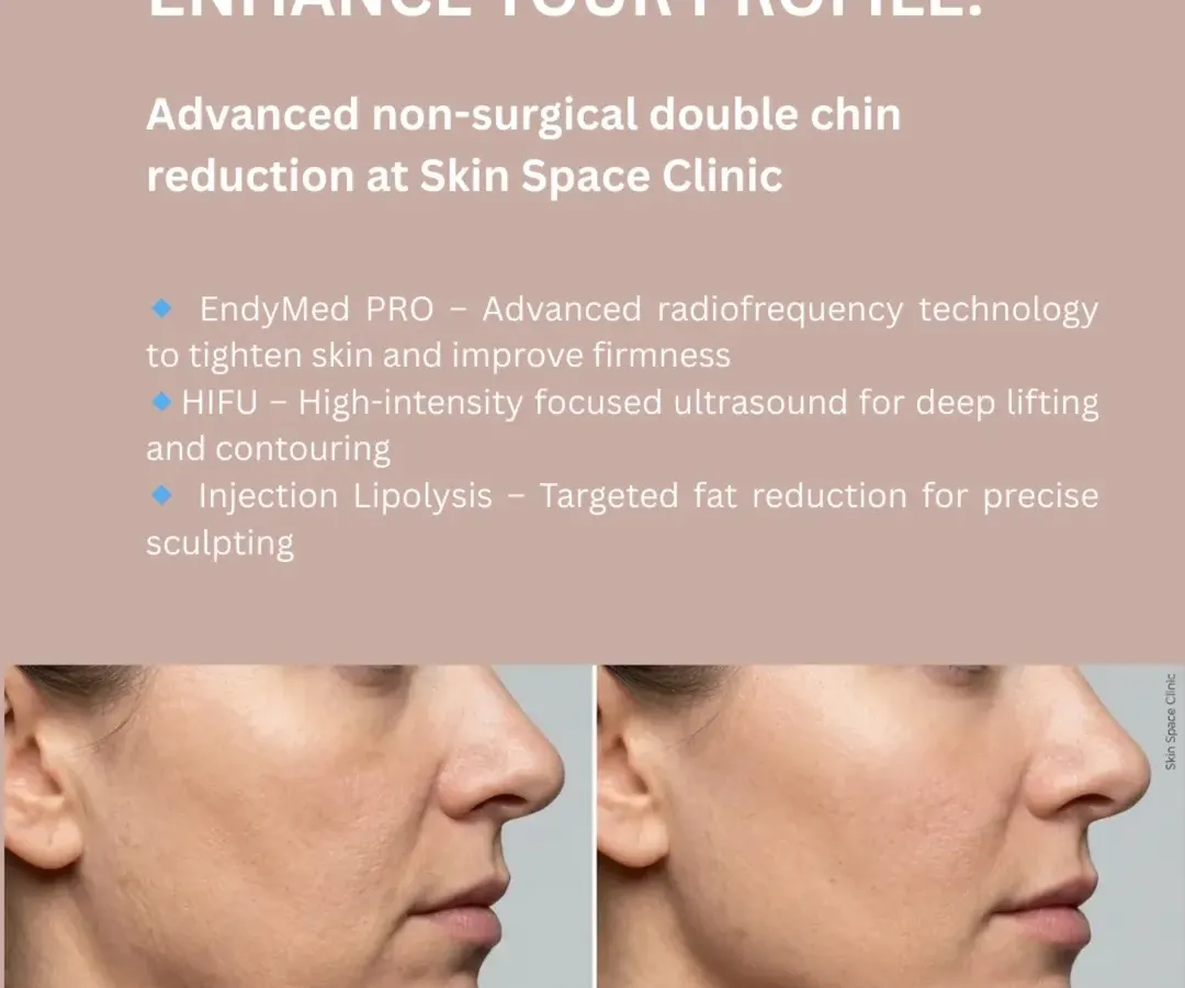A defined jawline can transform your entire profile. We achieve natural-looking, non-surgical double chin reduction using a combination of advanced technologies. Our approach includes EndyMed PRO for radiofrequency skin tightening, HIFU for deep tissue lifting, and targeted injection lipolysis to precisely sculpt and reduce fat.