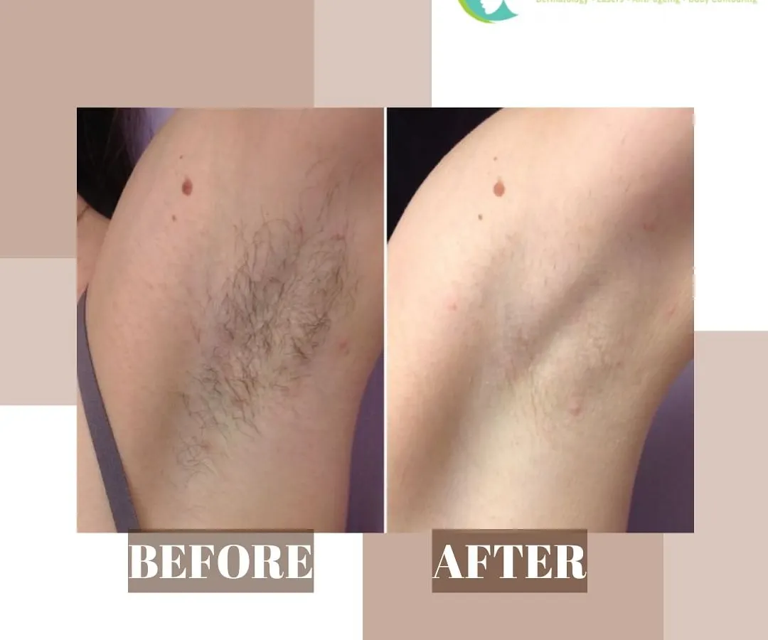 This before and after image shows the significant reduction of underarm hair after a course of laser treatments. The result is smooth, clear skin, free from the dark shadow of hair, irritation, and ingrown hairs often caused by shaving.