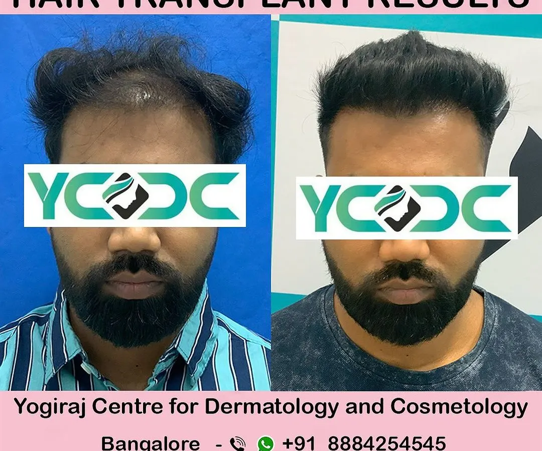 A frontal view of a successful FUE hair transplant. I meticulously design the hairline to frame the face naturally, avoiding any signs of artificiality. The result is a fuller head of hair that looks and feels like your own.