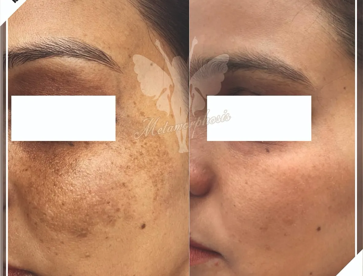 Stubborn pigmentation and sun damage don't stand a chance. Here you can see a significant clearing of hyperpigmentation, revealing a brighter and more even skin tone using a tailored plan of peels and laser sessions.