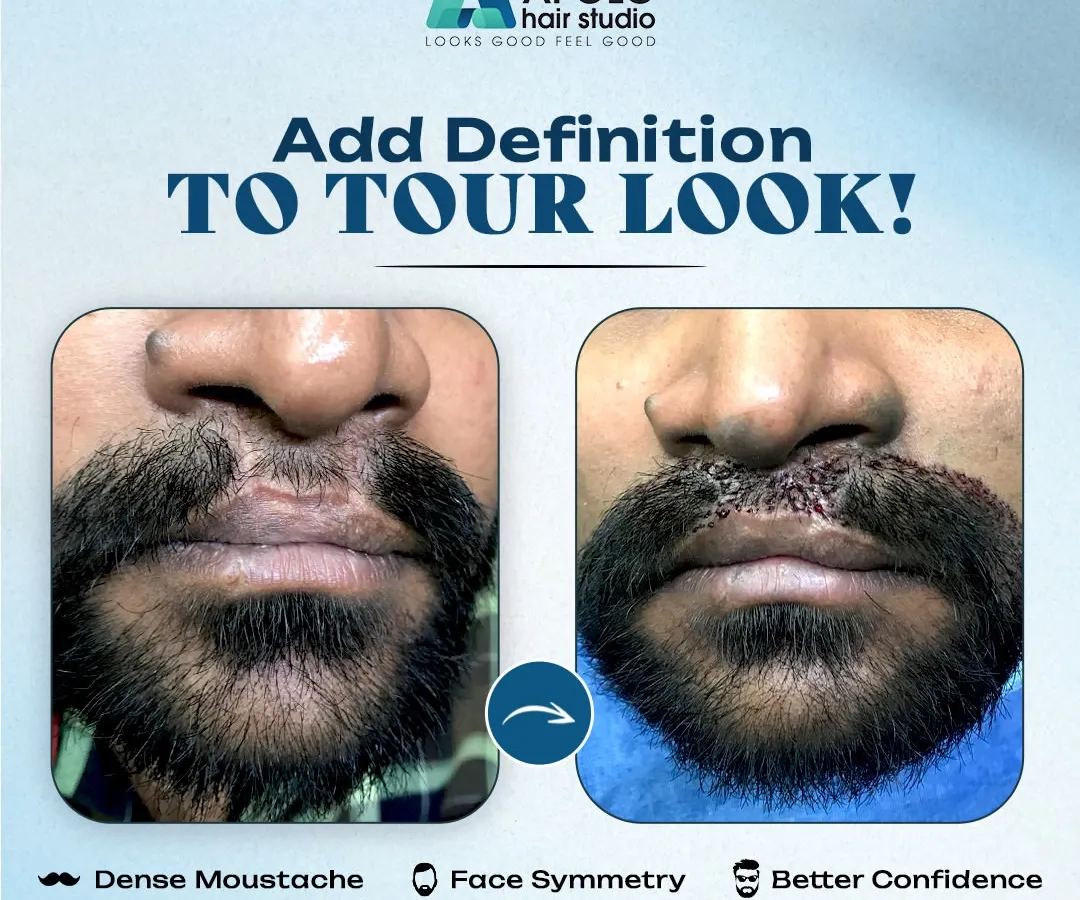 A moustache can define your entire look, and we help clients achieve that. This comparison shows how we performed a moustache transplant to create a dense, symmetrical, and full moustache, significantly improving facial symmetry and confidence.