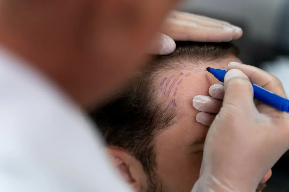 Precision is the foundation of a successful hair transplant. Here, I am carefully marking the new hairline for a client before a Follicular Unit Extraction (FUE) procedure. This planning stage is crucial to ensure the final result looks completely natural and complements your features.