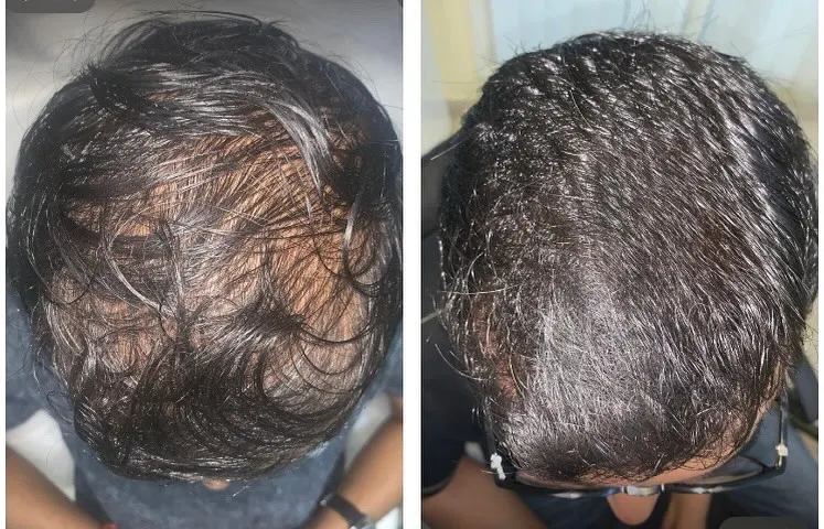 This image shows the significant improvement in hair density and scalp coverage for a patient after completing a customized hair regrowth plan. The goal of my treatment is not just to stop hair fall but to achieve tangible new growth, resulting in fuller and healthier hair.