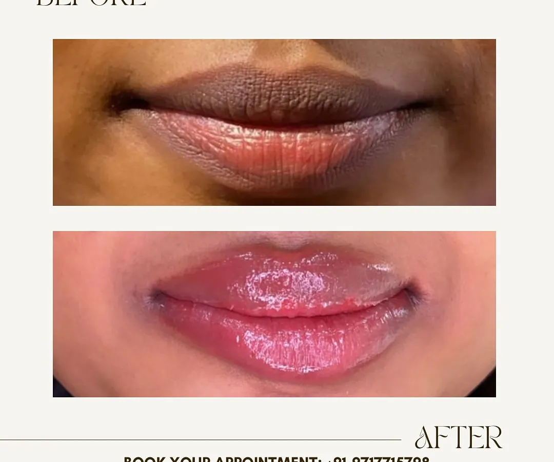 See the transformation with my permanent lip blush service. I corrected the dark pigmentation and gave her lips a beautiful, natural pink tint. This is perfect for anyone tired of reapplying lipstick and wanting an effortlessly defined look.