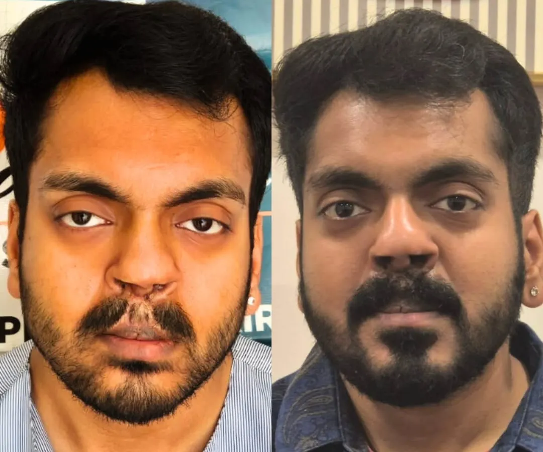Here you can see a direct before and after comparison for the same patient. We successfully filled in the patchy areas on his lower beard and created a full, natural-looking moustache over the difficult scar tissue on his upper lip using a targeted FUE transplant.