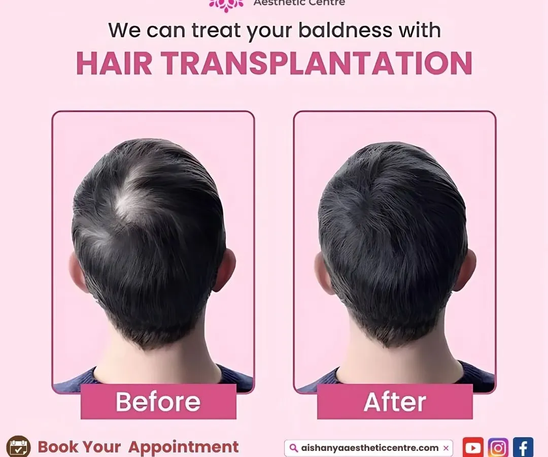 For advanced hair loss, a hair transplant can be a life-changing solution. Here is a clear example of how I create a natural, dense hairline, permanently restoring hair to a previously bald area.