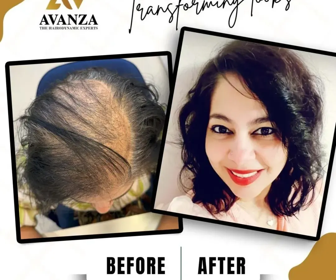 Hair loss in women requires a delicate and artistic approach. We addressed the thinning at her crown and parting line, resulting in this beautiful, voluminous look that has brought back her smile and confidence. The after photo is a selfie she sent us, and we couldn't be happier for her.