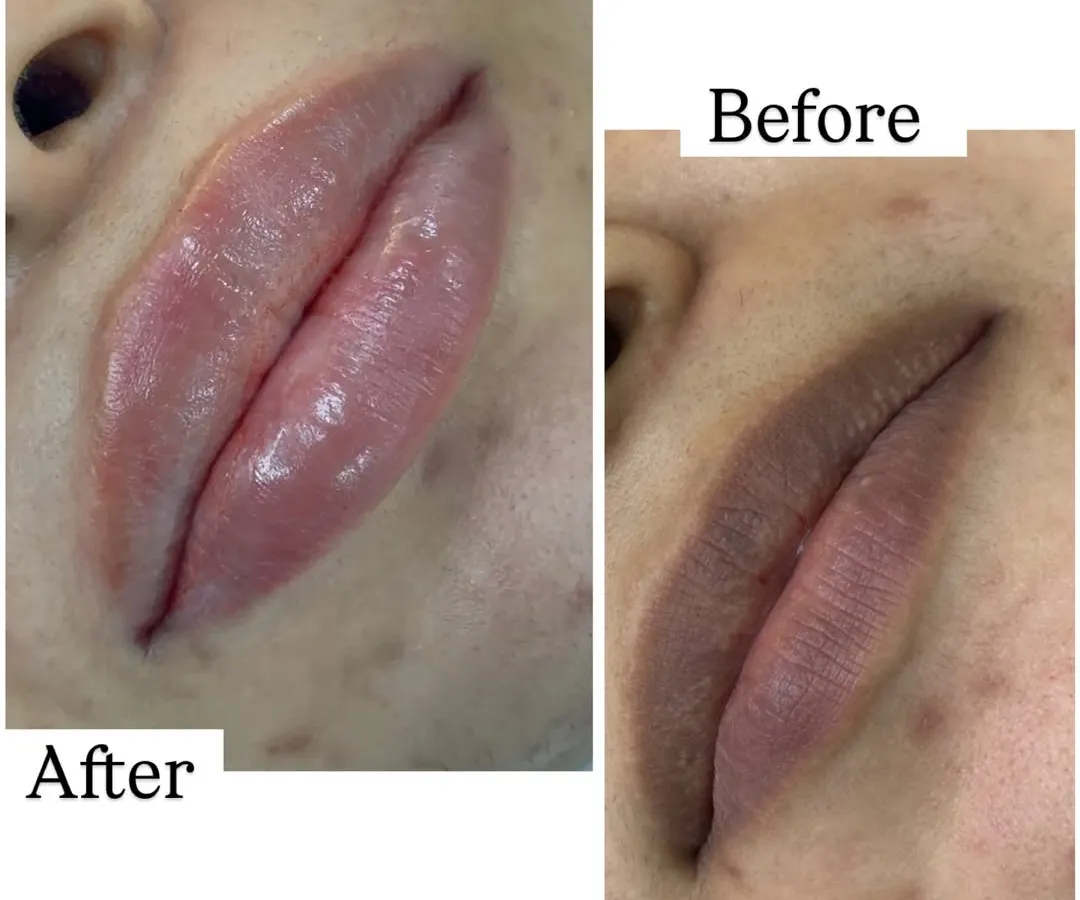 For anyone with pigmented lips, lip neutralization is a game changer. This before and after shows how I corrected the darker tones to create a healthy, even, and naturally pink pout.
