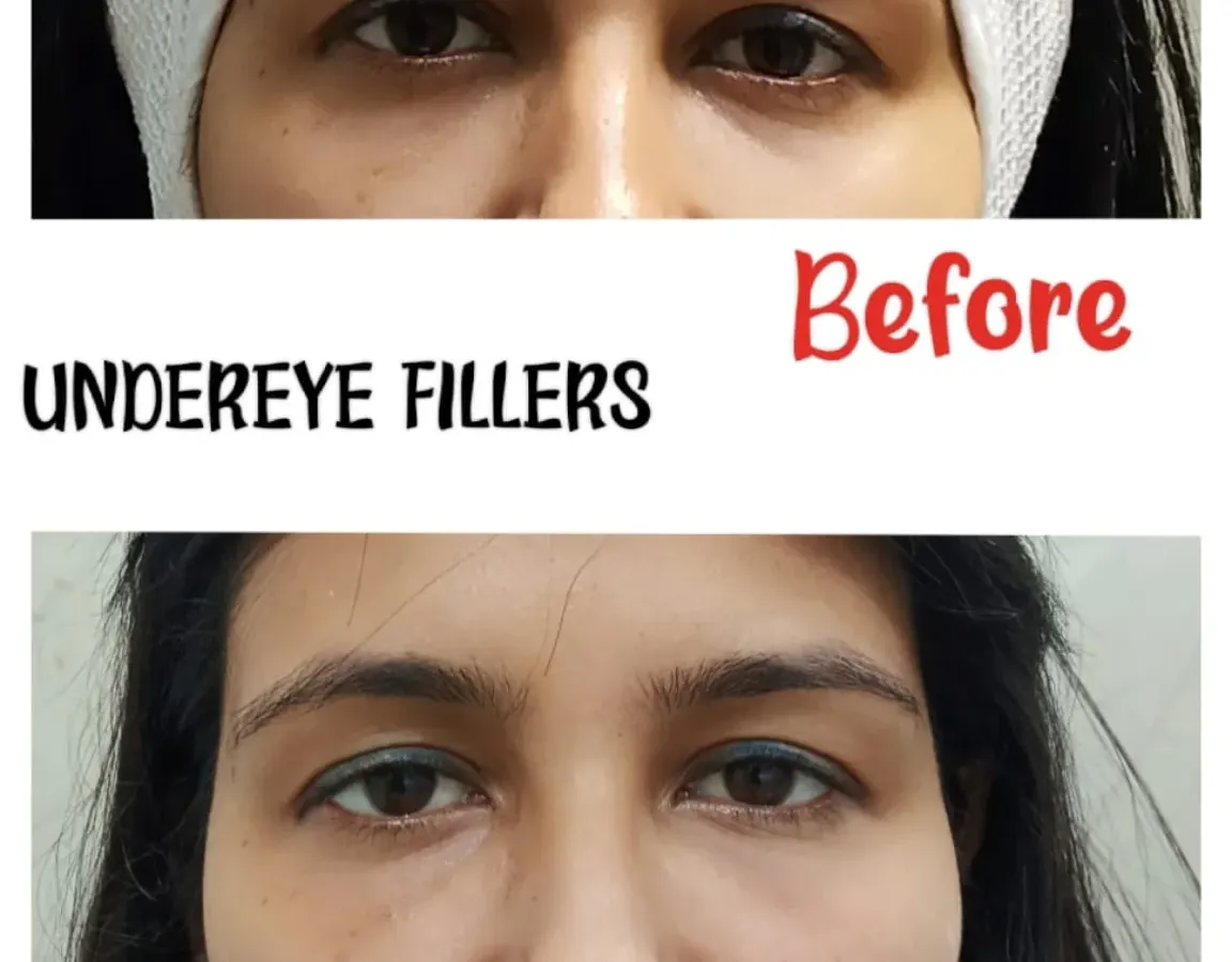 This before-and-after image clearly shows the results of our under-eye filler treatment. We effectively reduced the appearance of hollows and dark circles, resulting in a brighter, more rested, and rejuvenated look for our client.