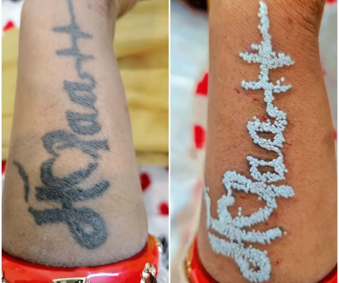 Here is a direct comparison showing a client's forearm tattoo before treatment and immediately after one session. The white frosting indicates the laser has successfully shattered the ink particles beneath the skin, starting the natural fading process.