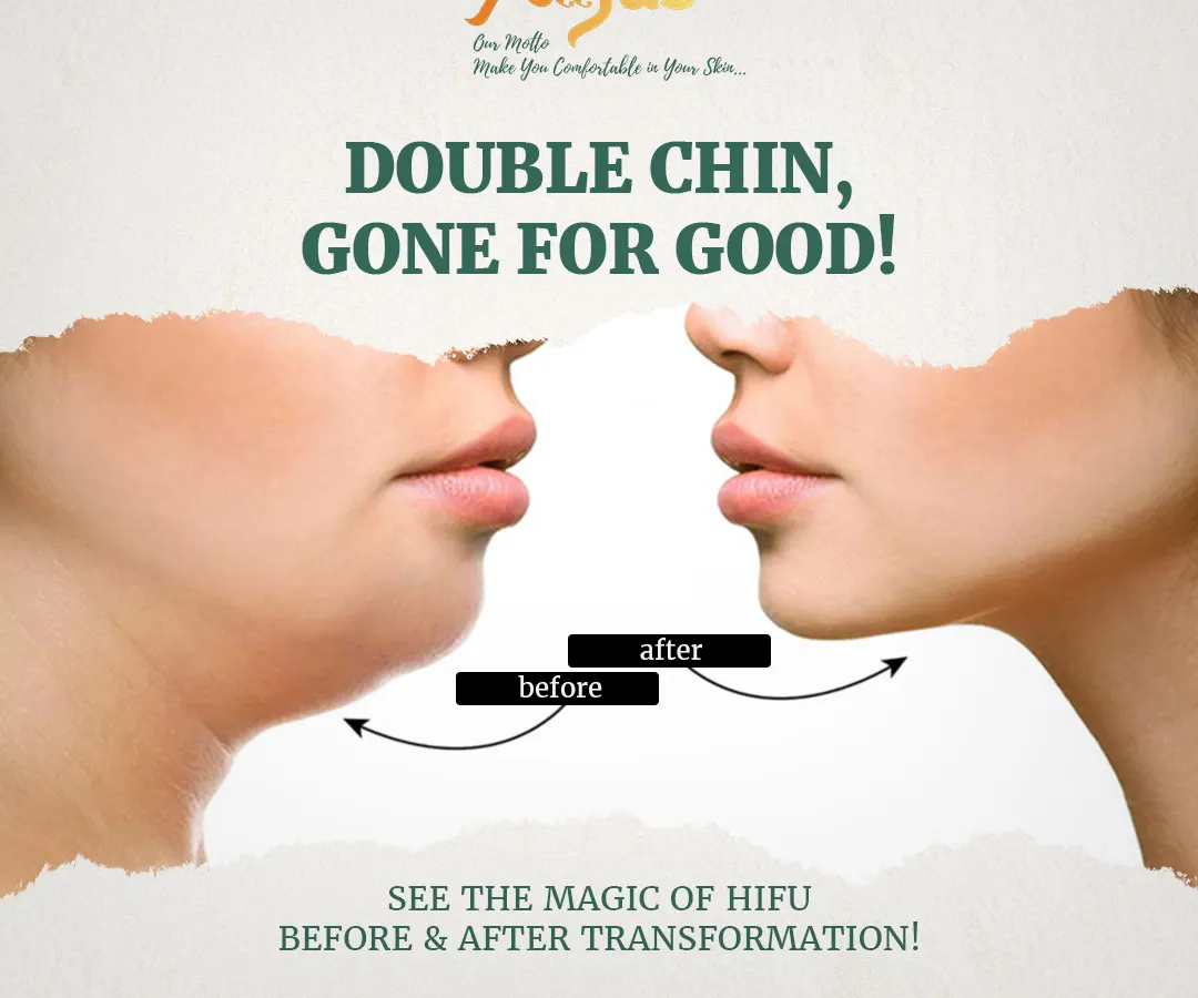 A defined jawline can transform your profile. Here you can see a clear before and after result of using non-surgical HIFU treatment to reduce a double chin. This procedure uses ultrasound to tighten the skin and melt fat, creating a sharper, more contoured look without any surgery.