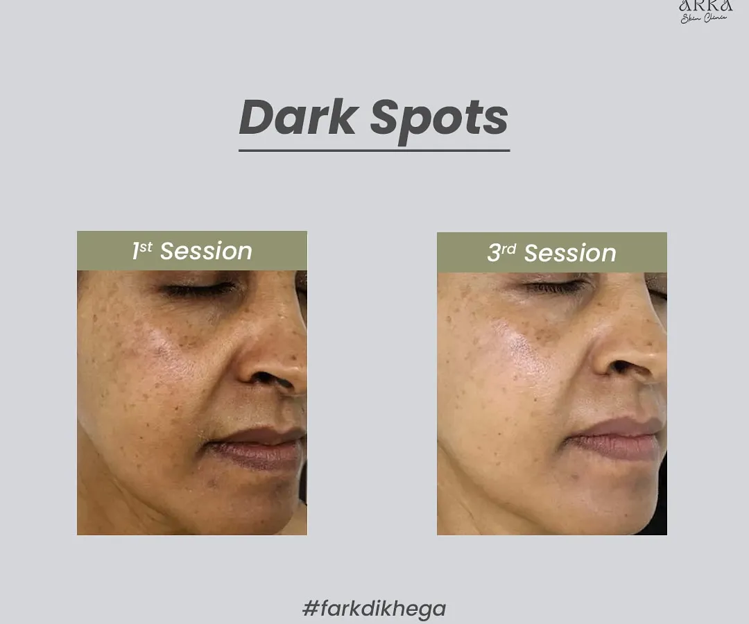 This is what I mean when I say "fark dikhega" (the difference will be visible). This before and after shows the significant reduction of dark spots and pigmentation after just three sessions. We achieved this by targeting the root cause of hyperpigmentation for clear, lasting results.