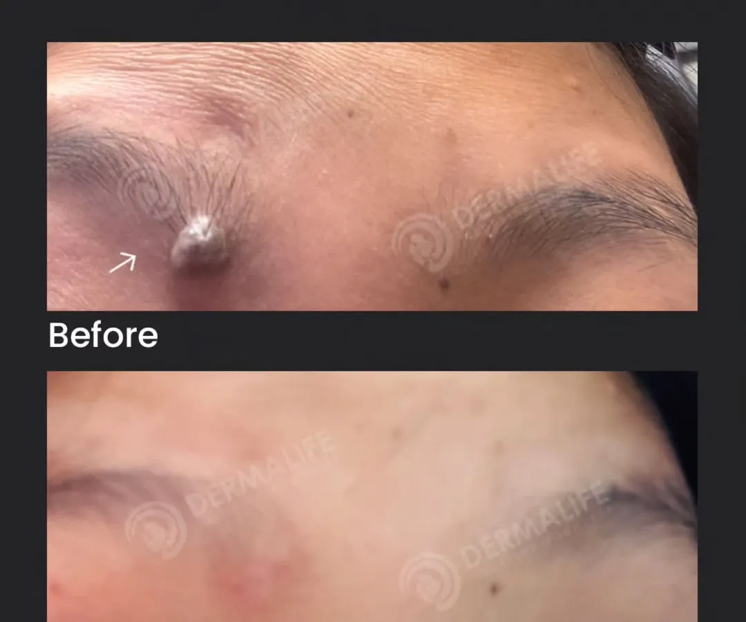 Here you can see the result just two months after a surgical mole removal. My technique focuses on complete removal with precision to ensure the mole does not return and to leave behind the most minimal scar possible. The final result is clear, smooth skin.