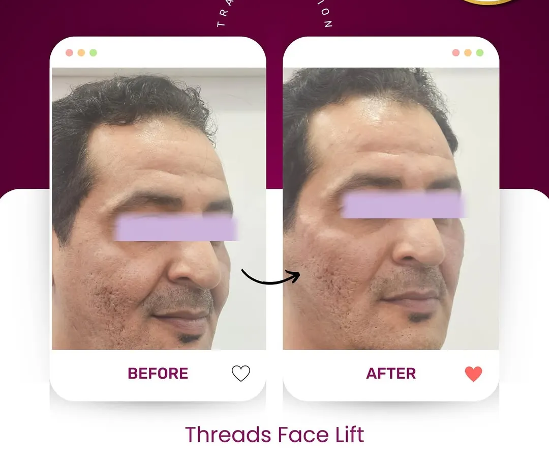 This is a perfect example of what a thread facelift can achieve. You can see a clear, yet natural-looking lift and improved contour in the 'after' photo. We achieved this without surgery by using dissolvable threads to lift sagging skin and stimulate collagen.