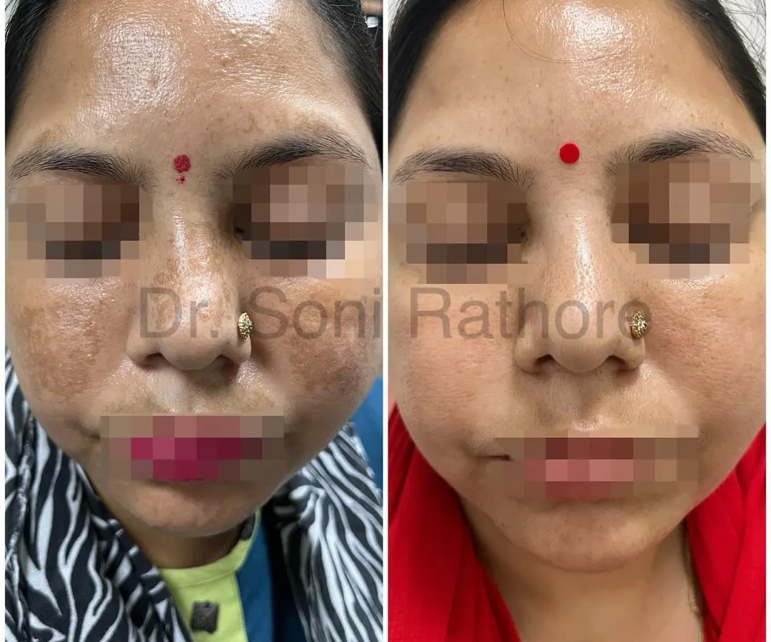A clear example of successful melasma treatment. Through a consistent, multi-step plan including prescription creams, chemical peels, and laser treatments, we achieved a dramatic reduction in hyperpigmentation and a much more even skin tone.