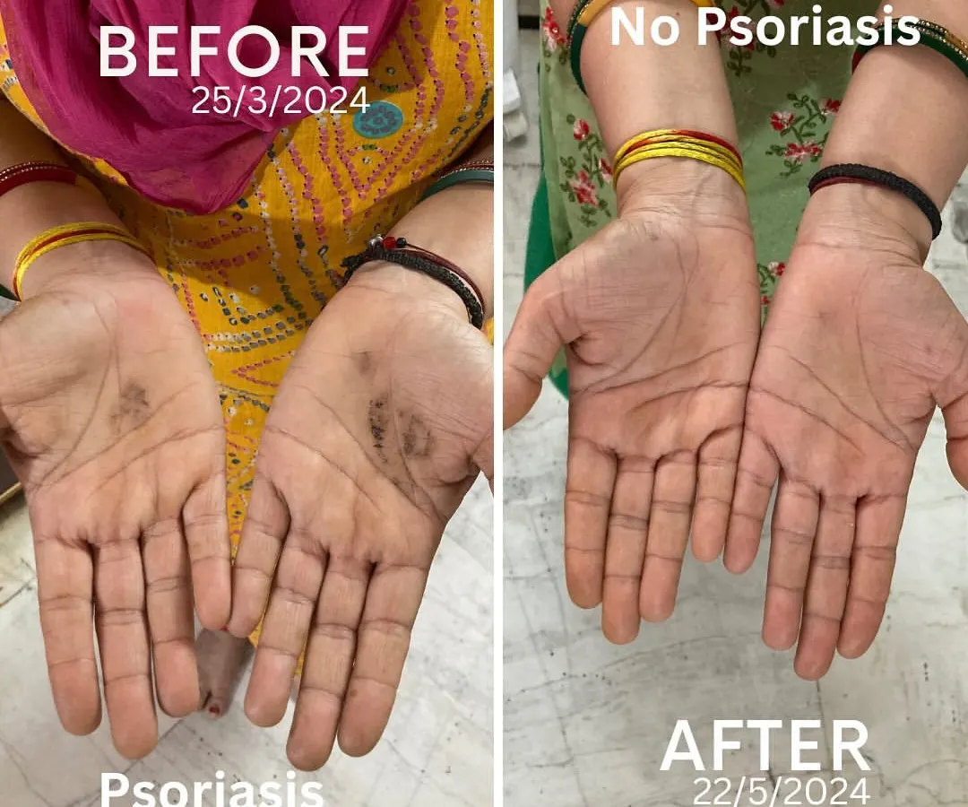 This is why I do what I do. This is my own mother's hand, before and after two months of following a Yogic and Ayurvedic lifestyle I designed for her. She suffered from Psoriasis for years with no relief from modern medicine, but with consistent, natural practice, we healed it completely. This is the power of real yoga.