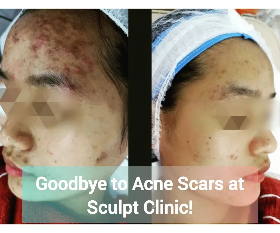 Here you can see a remarkable improvement in severe acne and subsequent scarring. Our personalized treatment plans target active acne to reduce inflammation and then focus on smoothing skin texture and fading scars for a clearer complexion.