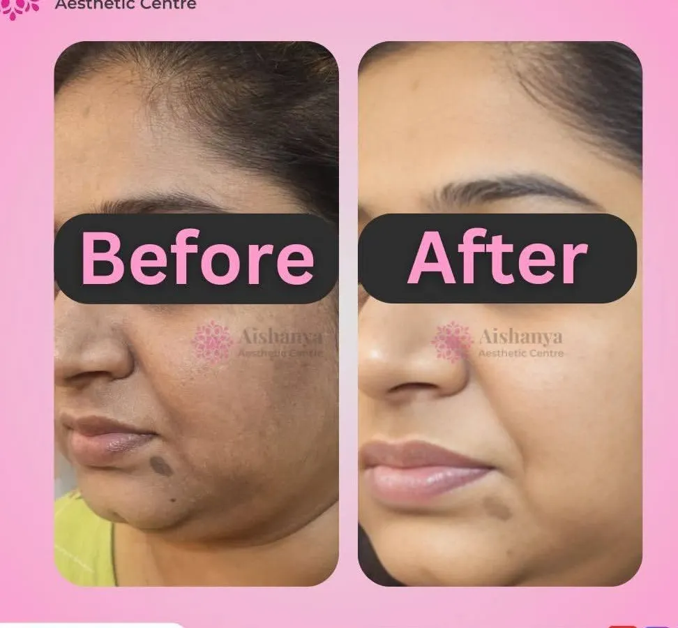 Pigmentation and uneven skin tone are very common concerns, but they don't have to be permanent. This before and after showcases the significant clearing of dark spots and melasma, resulting in a much brighter and more even complexion.