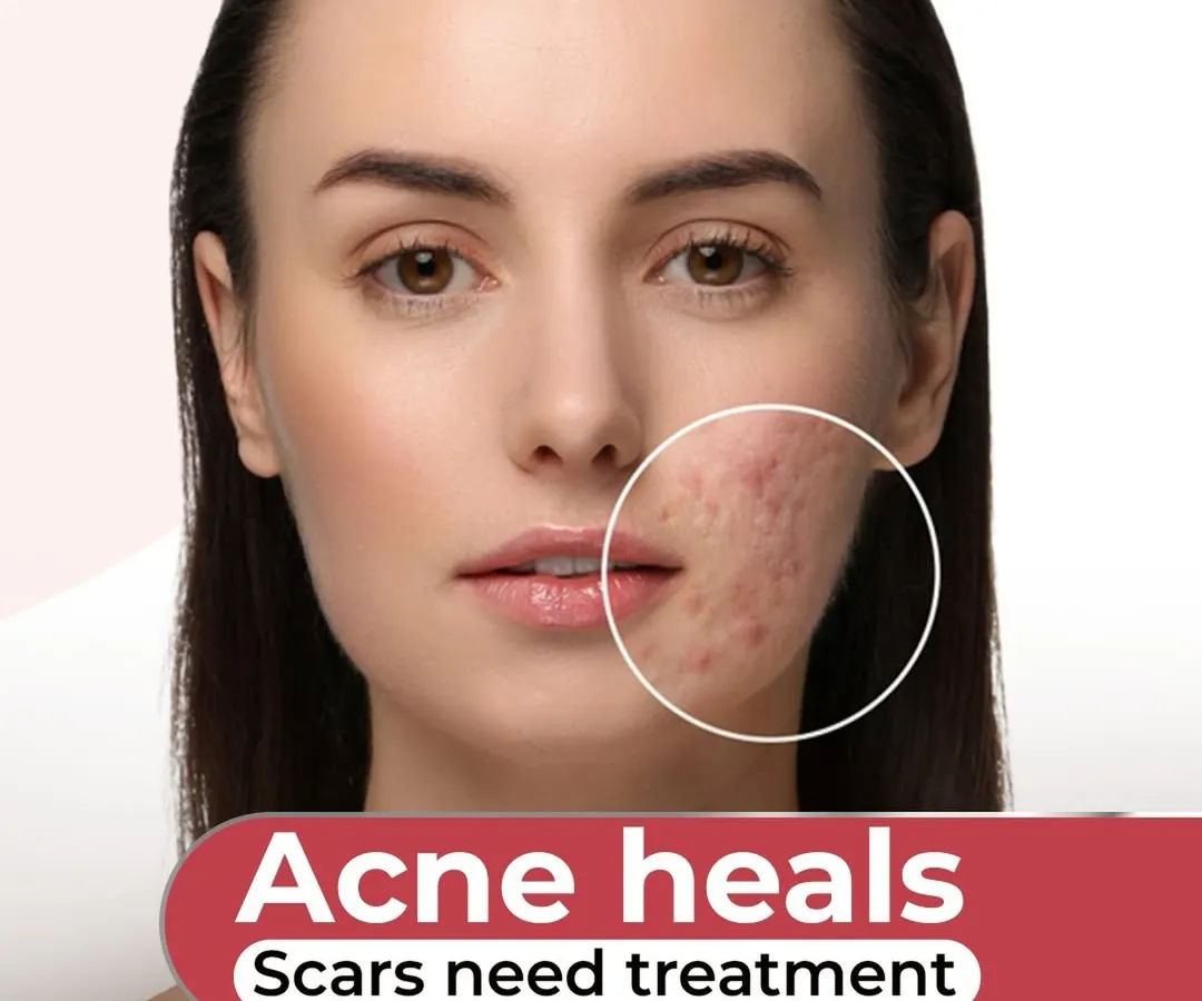 Many people believe acne marks will fade on their own, but this is a myth. While a pimple heals, the scar it leaves behind is a permanent change in skin texture that requires professional treatment. My approach is to assess the scar depth and your skin's healing capacity to create a strategy for real, lasting smoothness.