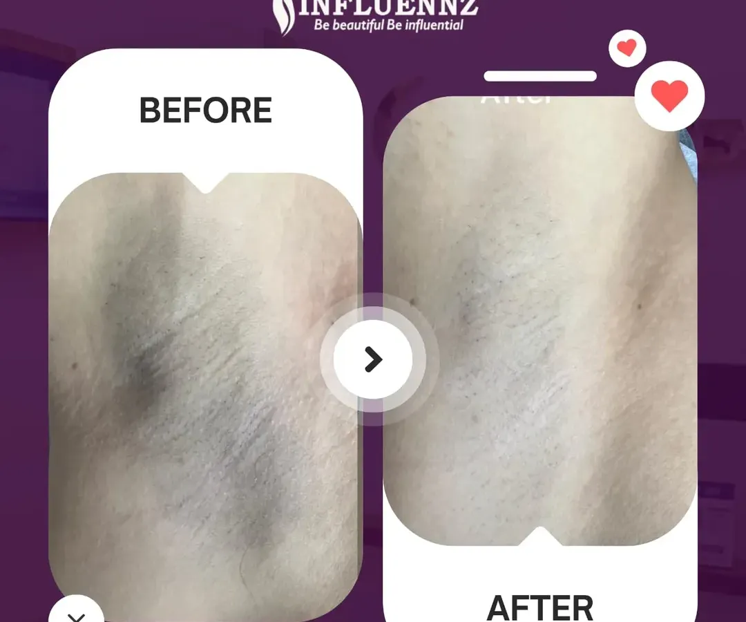 This before and after image shows a significant reduction in underarm pigmentation after a specialized brightening treatment. The skin appears visibly lighter, smoother, and more even-toned, helping restore confidence.