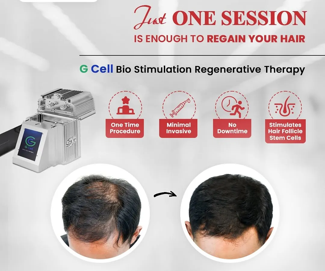My GCell Bio Stimulation therapy is a powerful, one-time procedure for hair regeneration. This minimally invasive treatment uses your body's own cells to stimulate dormant hair follicles with no downtime, offering a significant improvement in hair density as shown in this before and after result.