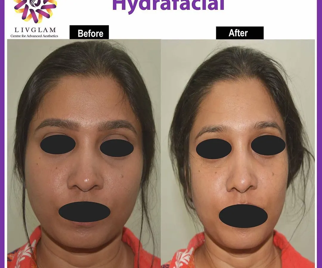 Experience an instant glow-up with our medical-grade Hydrafacial. This client's 'after' photo shows visibly brighter, more hydrated, and refreshed skin with improved tone and texture immediately following the treatment.