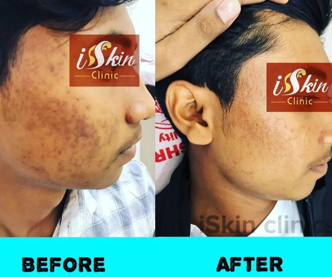 Here is a clear example of a successful transformation, showing the 'before' state with active acne and post-inflammatory hyperpigmentation, and the 'after' state with clearer skin. We create customized acne treatment plans to address both breakouts and resulting discoloration.
