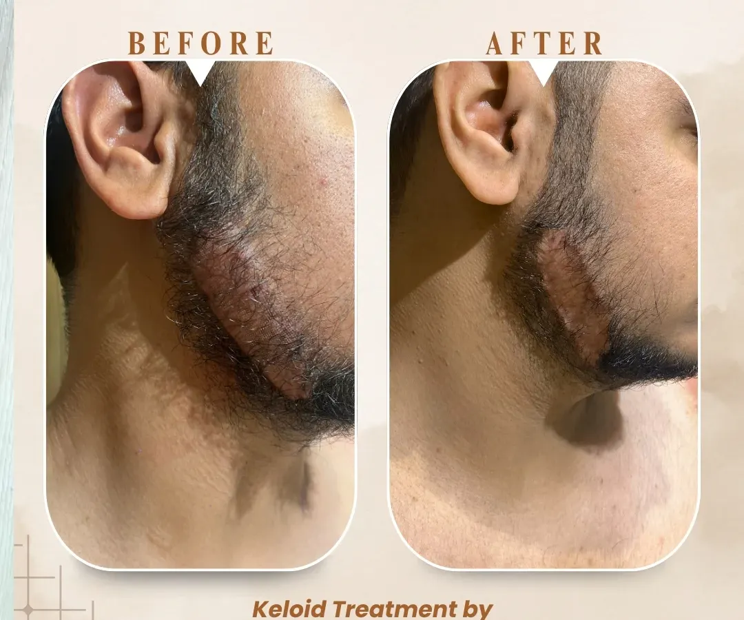 Treating keloids on the face and neck requires a delicate, precise approach. This patient had a prominent keloid along his jawline. We used a combination therapy to carefully flatten and soften the scar tissue over a few sessions, significantly improving its appearance and texture.