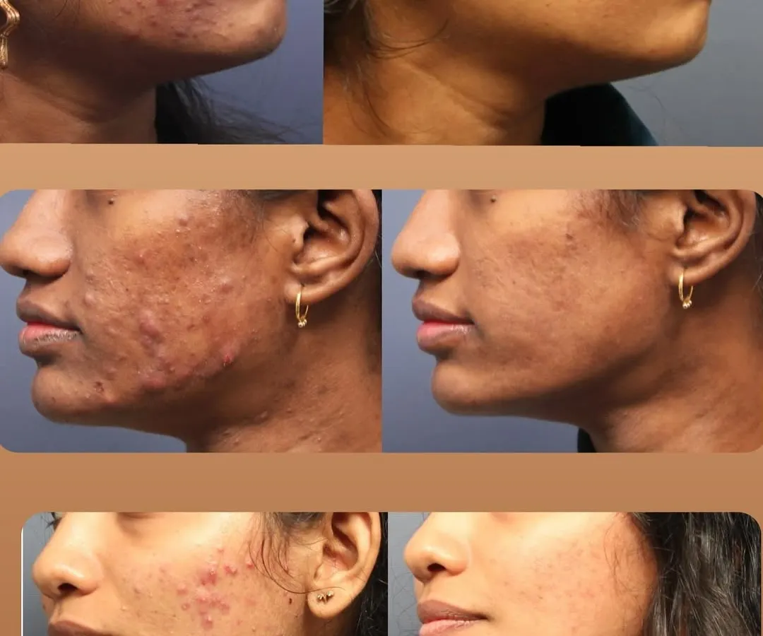 A Life-Changing Acne Transformation. This before-and-after gallery shows the journey from severe, painful acne to clear, healthy skin. My approach combines medical diagnosis with a personalized treatment plan to not only clear active breakouts but also improve skin texture and confidence.